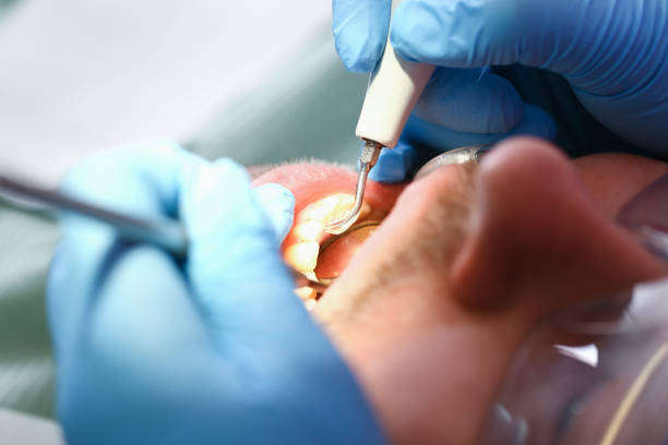 Best Emergency Dentist for Knocked-Out Tooth in South Miami Heights, FL