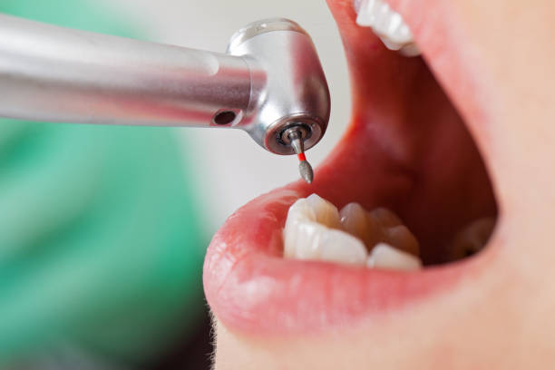 Best Emergency Dentist for Lost Fillings or Crowns in South Miami Heights, FL
